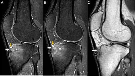 patellar tendon enthesopathy